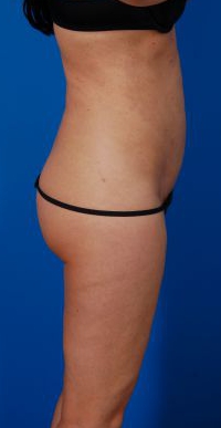 Female body, before Revision Liposuction treatment, r-side oblique view, patient 4