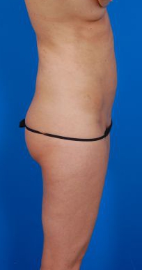 Female body, before - Revision Liposuction treatment, r-side view, patient 4