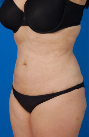 Female body, after Liposuction Revision treatment, l-side oblique view, patient 5