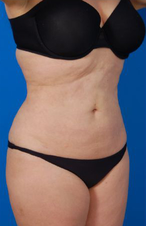 Female body, after Liposuction Revision treatment, r-side oblique view, patient 5