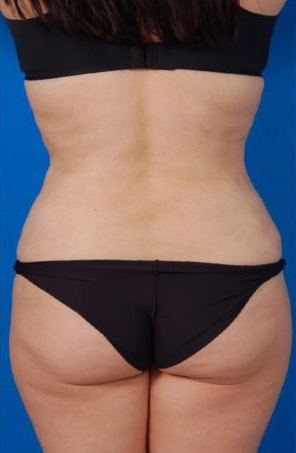 Female body, after Liposuction Revision treatment, back side view, patient 5
