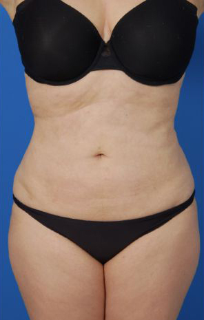 Female body, after Liposuction Revision treatment, front view, patient 5