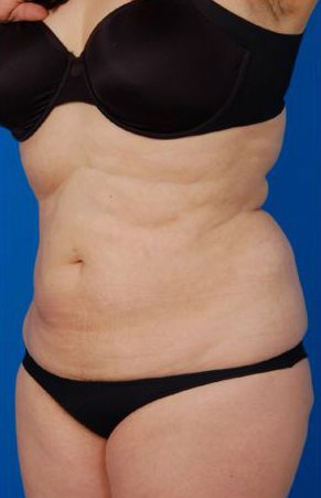 Female body, before Liposuction Revision treatment, l-side oblique view, patient 5