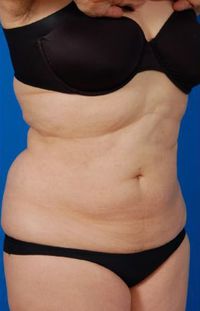 Female body, before Liposuction Revision treatment, r-side oblique view, patient 5