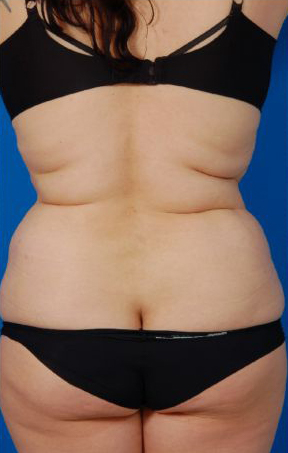 Female body, after Liposuction Revision treatment, back side view, patient 5