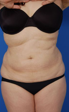 Female body, before - Liposuction Revision treatment, front view, patient 5
