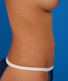 Female body, before Liposuction Revision treatment, r-side view, patient 6