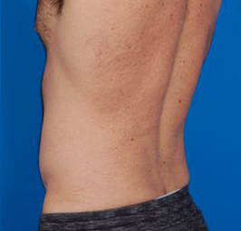 Male body, after Liposuction For Men treatment, back side oblique view, patient 5