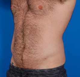 Male body, after Liposuction For Men treatment, l-side oblique view, patient 5