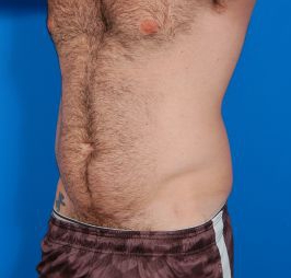 Male body, before Liposuction For Men treatment, l-side oblique view, patient 5