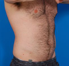Male body, after Liposuction For Men treatment, r-side oblique view, patient 5