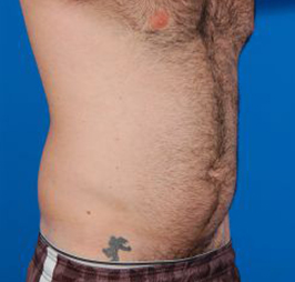 Male body, before - Liposuction For Men treatment, r-side oblique view, patient 5