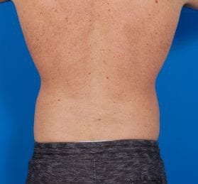 Male body, after Liposuction For Men treatment, back side view, patient 5