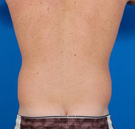 Male body, before Liposuction For Men treatment, back side view, patient 5