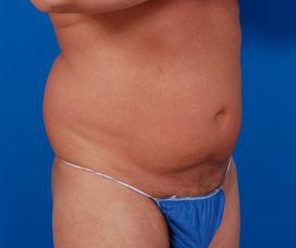 Male body, before Liposuction For Men treatment, r-side oblique view, patient 6