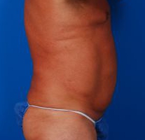 Male body, after Liposuction For Men treatment, r-side view, patient 6