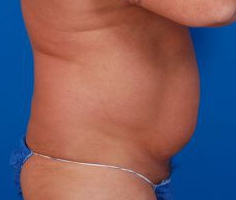 Male body, before Liposuction For Men treatment, r-side view, patient 6