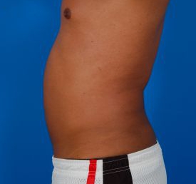 Male body, after Liposuction For Men treatment, l-side view, patient 7