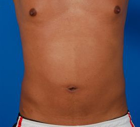 Male body, after Liposuction For Men treatment, front view, patient 7