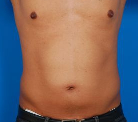 Male body, before Liposuction For Men treatment, front view, patient 7