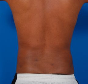 Male body, after Liposuction For Men treatment, back side view, patient 7
