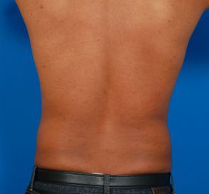 Male body, before Liposuction For Men treatment, back side view, patient 7