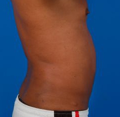 Male body, after Liposuction For Men treatment, r-side view, patient 7