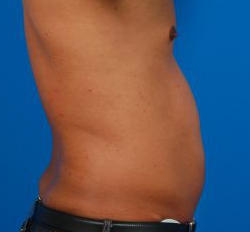 Male body, before Liposuction For Men treatment, r-side view, patient 7