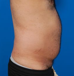 Male body, before Liposuction For Men treatment, r-side view, patient 8
