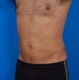 Male body, after Liposuction For Men treatment, l-side oblique view, patient 8