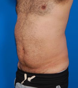 Male body, before Liposuction For Men treatment, l-side oblique view, patient 8