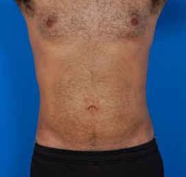 Male body, after Liposuction For Men treatment, front view, patient 8