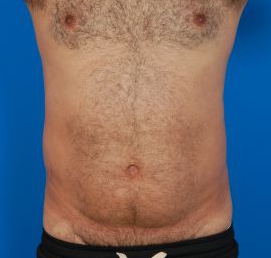 Male body, before Liposuction For Men treatment, front view, patient 8