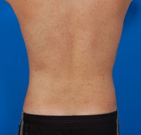 Male body, after Liposuction For Men treatment, back view, patient 8