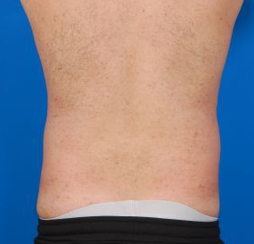 Male body, before Liposuction For Men treatment, back view, patient 8