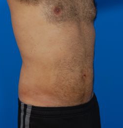 Male body, after Liposuction For Men treatment, r-side oblique view, patient 8