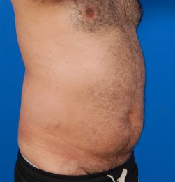 Male body, before Liposuction For Men treatment, r-side oblique view, patient 8