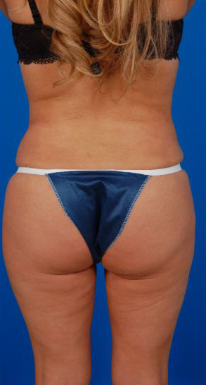 Revision Liposuction Photo Case 7 after Back view
