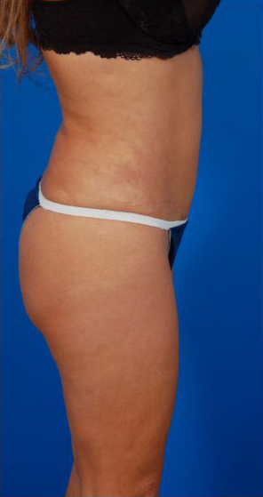 Revision Liposuction Photo Case 7 after Right view