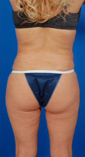 Revision Liposuction Photo Case 7 before Back view