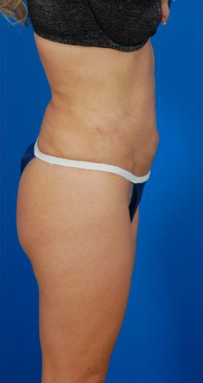 Revision Liposuction Photo Case 7 before Right view