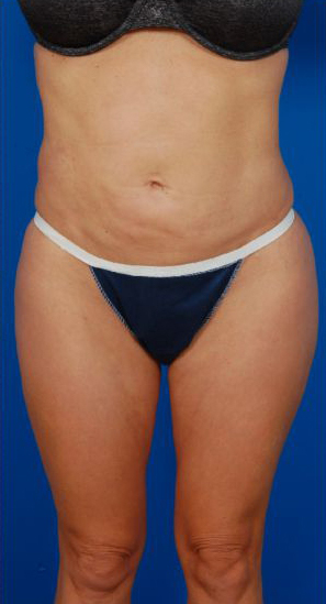 Female body, before Liposuction Revision treatment, front view, patient 7