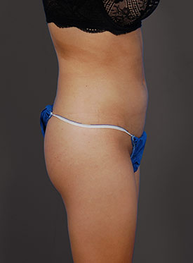 Woman's body, after brazilian butt lift treatment, r-side view, patient 1