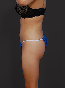 Woman's body, after brazilian butt lift treatment, l-side view, patient 1