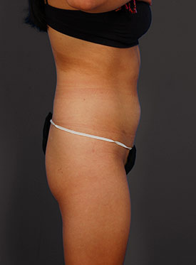 Woman's body, before brazilian butt lift treatment, r-side view, patient 1