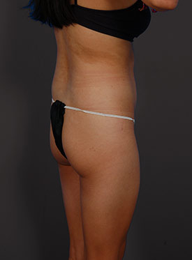 Woman's body, before brazilian butt lift treatment, r-side oblique view, patient 1