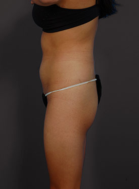 Woman's body, before brazilian butt lift treatment, l-side view, patient 1