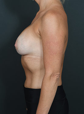Female body, after Breast Augmentation-with Implant treatment, l-side view, patient 36