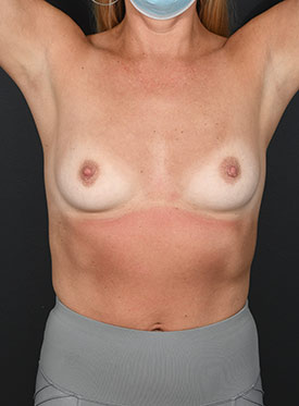 Female body, before Breast Augmentation-with Implant treatment, front view (hands up), patient 36