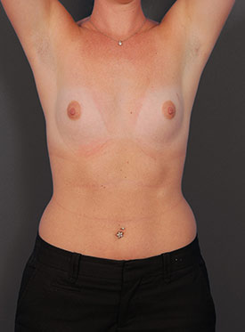 Female body, before Breast Augmentation-with Implant treatment, front view (hands up), patient 37